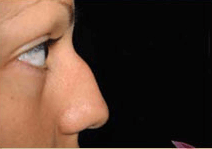 Nose Surgery
