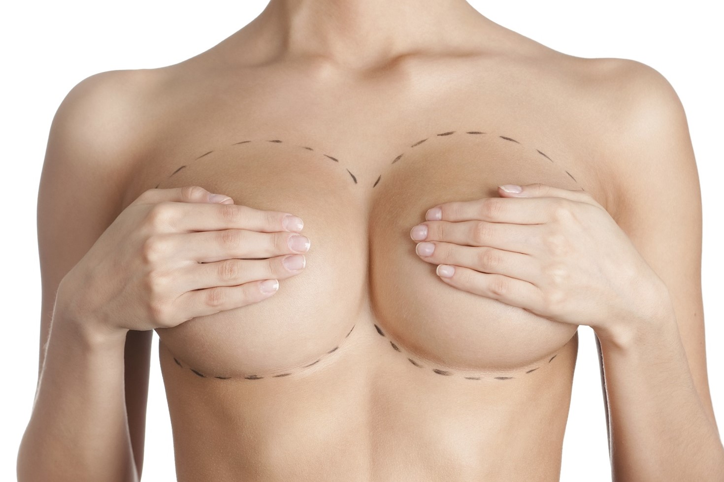 Breast Implants in Mexico