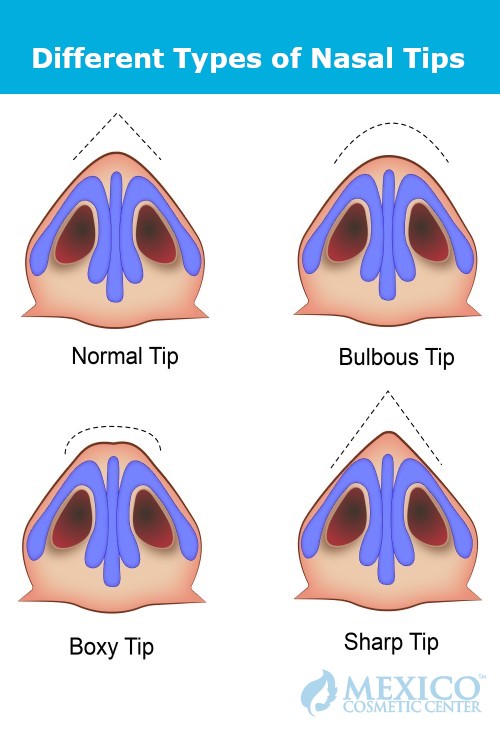 Different Types of Nasal tips Nose Jobs Rhinoplasty 500px