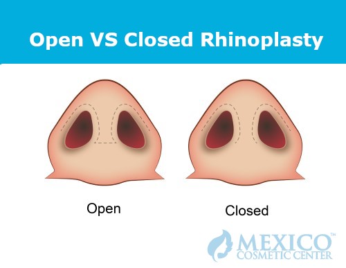Open Closed Rhinoplasty Nose Surgery Mexico Cosmetic Center Plastic Surgery 500px