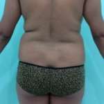 Before Brazilian Butt Lift + Liposuction