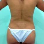 After Brazilian Butt Lift + Liposuction Picture 2