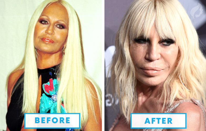 Donatella Versace Botched Plastic Surgery - 10 Failed Celebrity Plastic Surgeries