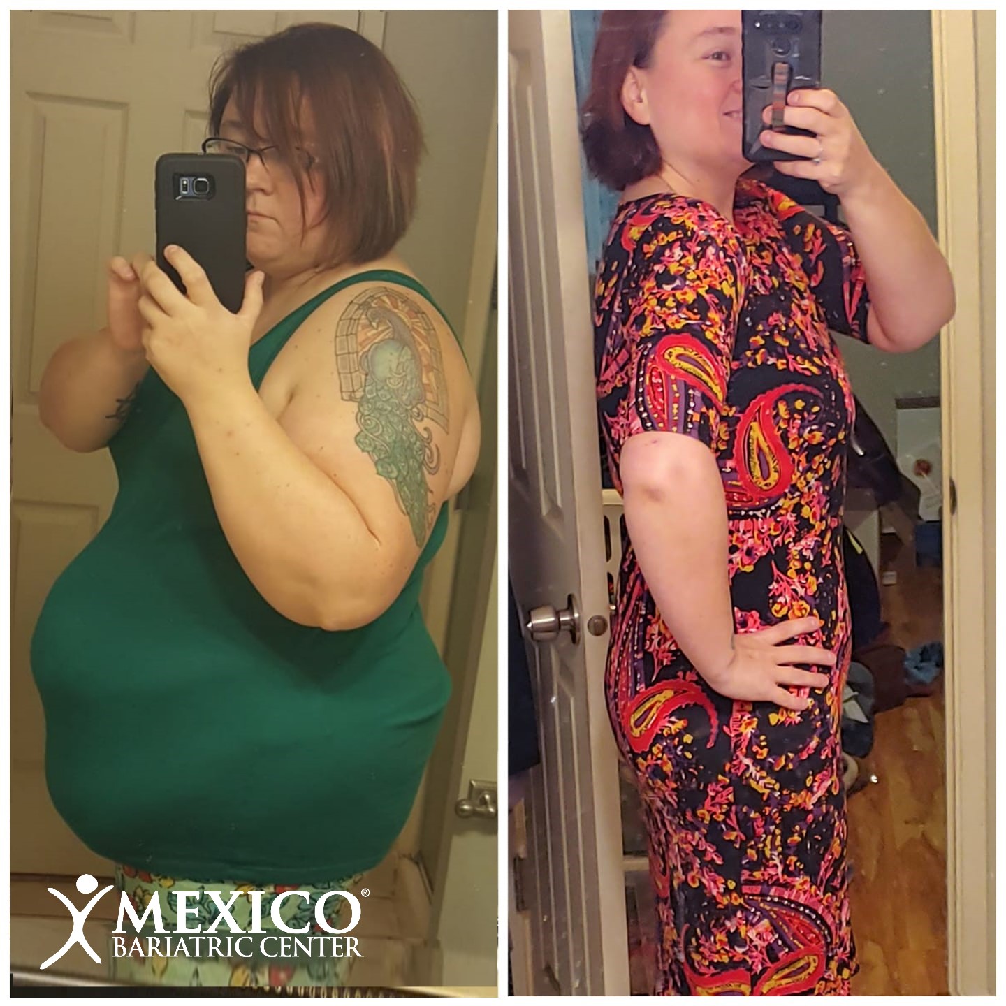 Jen L - Total transformation - Mexico Bariatric Center and Cosmetic Center