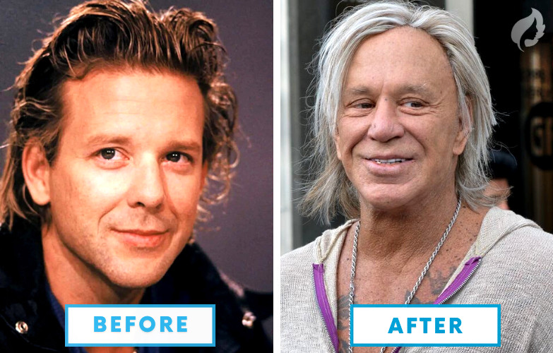 Mickey Rourke Botched Plastic Surgery - 10 Failed Celebrity Plastic Surgeries