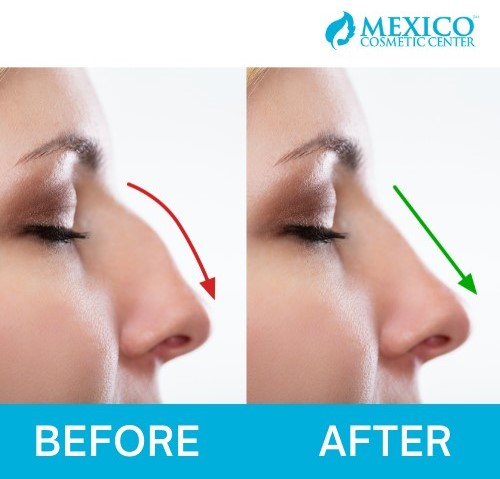 Before and after Rhinoplasty Nose Jobs Cosmetic Plastic Surgery Contouring Picture