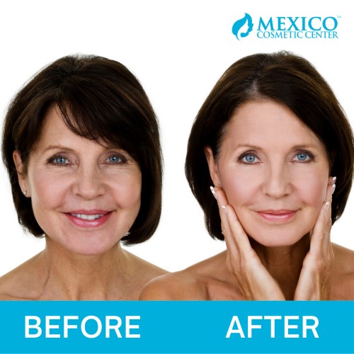 Before and after Rhinoplasty Nose Jobs Mexico Cosmetic Center Plastic Surgery Body Contouring Picture_500px