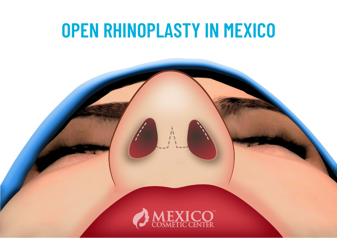 Open Rhinoplasty In Tijuana Mexico
