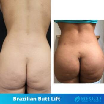 Brazilian Butt Lift  BBL