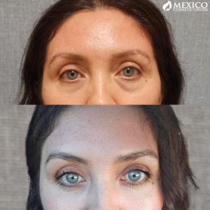 Face Lift Around Eyes Before and After -Mexico Cosmetic Center
