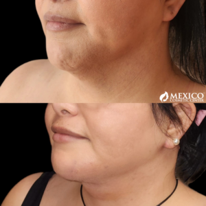 Face Lift Chin Area -Mexico Cosmetic Center