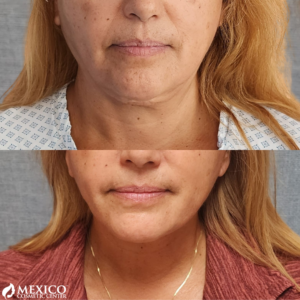 Face Lift Chin Before and After -Mexico Cosmetic Center