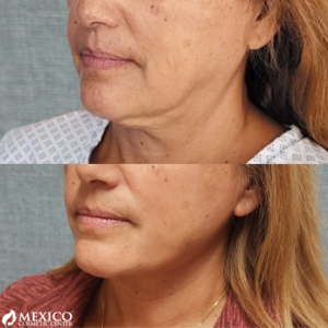 Face Lift Defined Jawline -Mexico Cosmetic Center