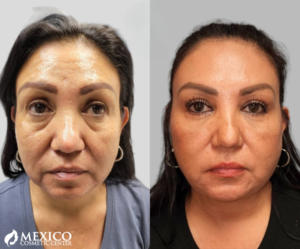Face Lift Female Profile -Mexico Cosmetic Center