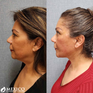 Face Lift Left View -Mexico Cosmetic Center