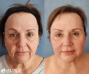 Face Lift Profile Before and After -Mexico Cosmetic Center