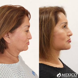 Face Lift Results -Mexico Cosmetic Center