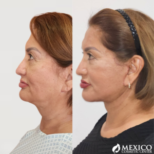 Face Lift Side Results -Mexico Cosmetic Center