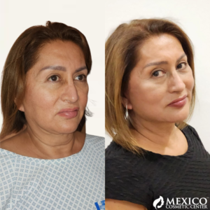 Face Lift Side View Before and After -Mexico Cosmetic Center