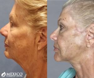 Older Female Patient Face Lift -Mexico Cosmetic Center