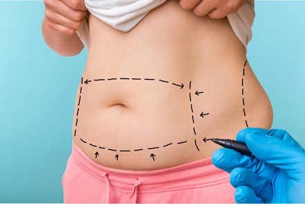Fat Reduction