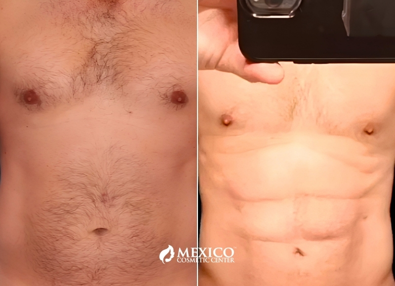 Male skin removal/lipo